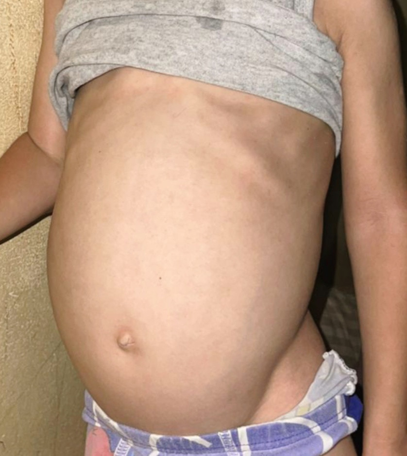 photo of Omar's enlarged tummy